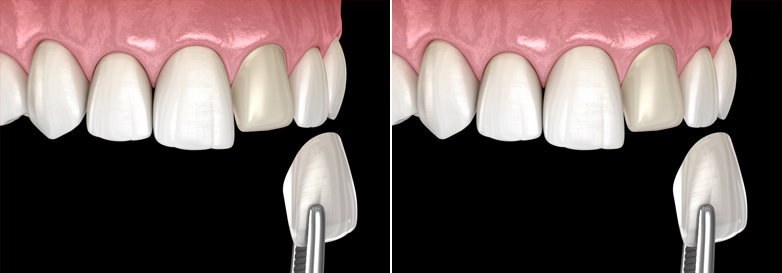 마음담은치과 전후사진