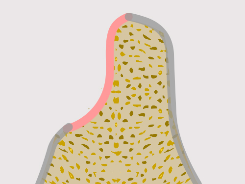 잇몸 뼈 소실 정도 진단