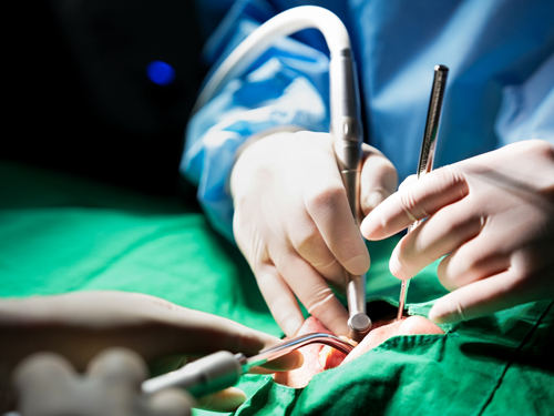 임플란트 식립 및 보철물 결합