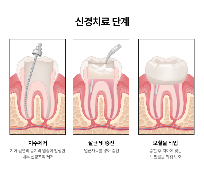 무삭제 라미네이트